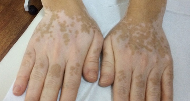 Vitiligo nasıl geçer? Vitiligo nedir? | Beyazlama hastalığı nasıl geçer